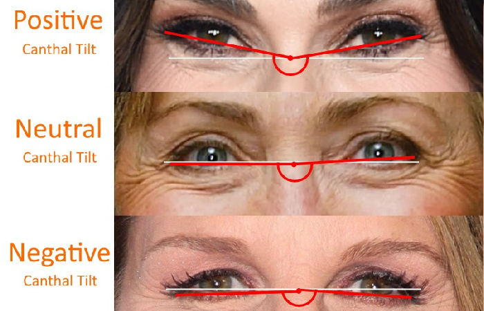 types of negative canthal tilt.png